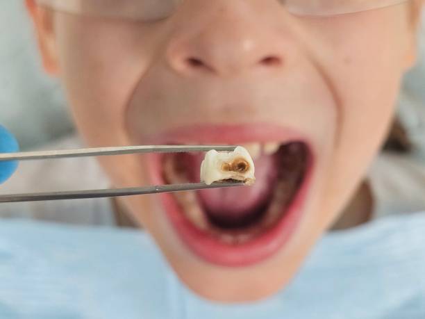 Best Emergency Dental Care for Broken or Chipped Teeth in Grundy Center, IA